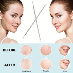 Blackhead Removal Tool Stainless Steel for Face and Nose