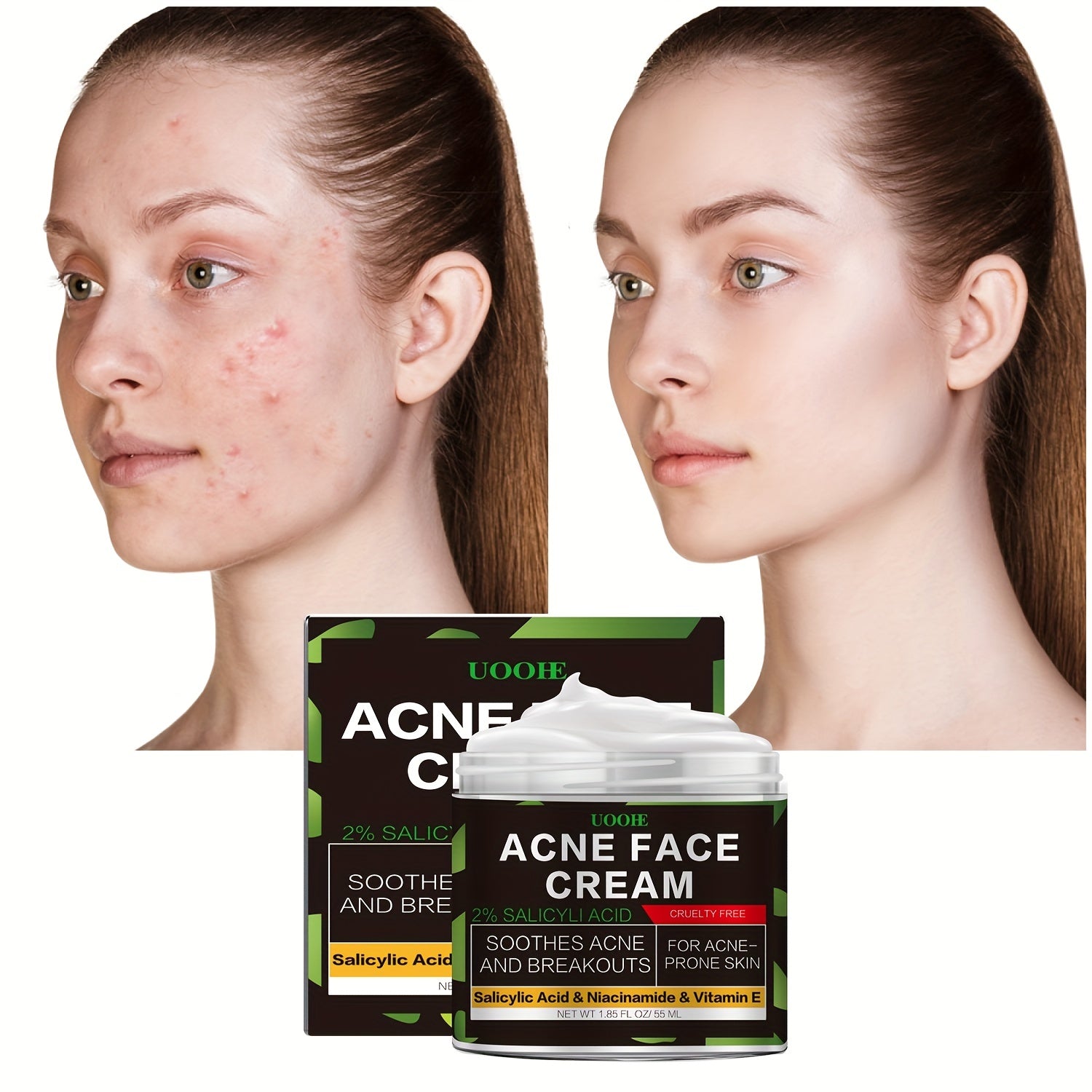 Acne Cream with Niacinamide & Salicylic Acid