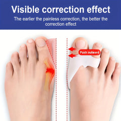 Silicone Toe Protector for Hallux Valgus Correction - Home and Night Use