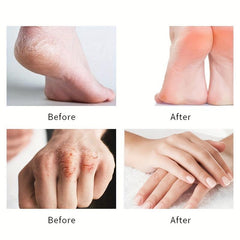 Urea Cream Stick 42 Plus Salicylic Acid 2 Foot Cream For Dry Cracked Feet Heels