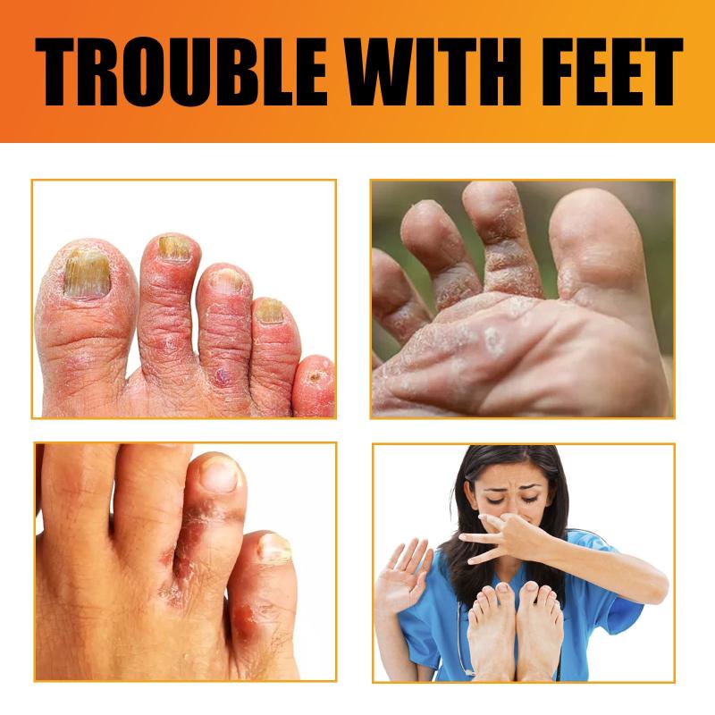 Athlete's Foot Cream for Dry Rough Cracked Skin