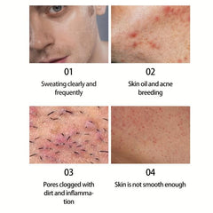 Acne Dark Spot Soap Bar for Face Body Cleansing Bath