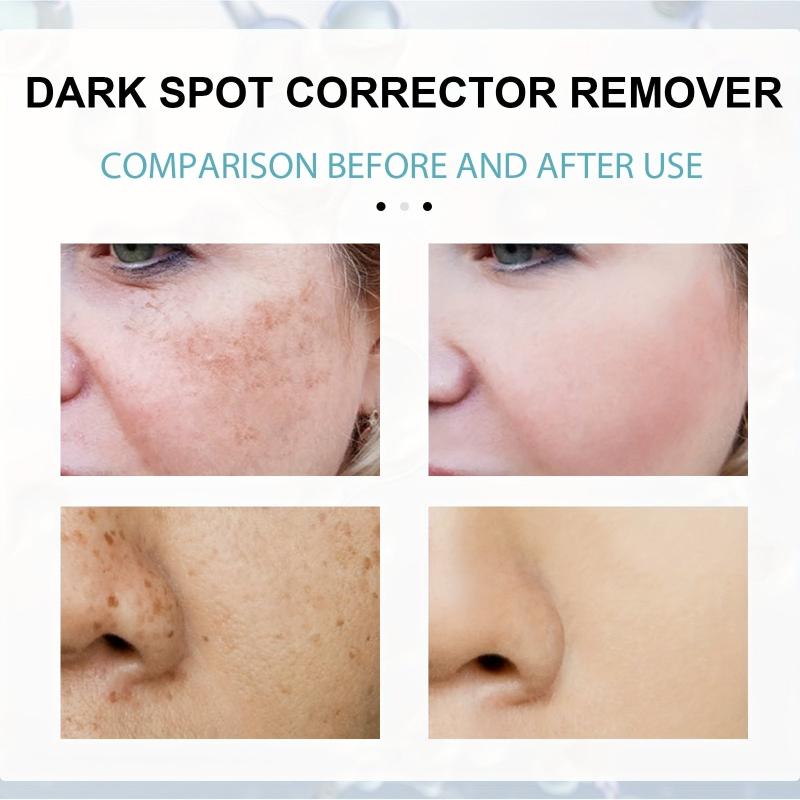 Dark Spot Removal Cream Face Moisturizing Rejuvenation
