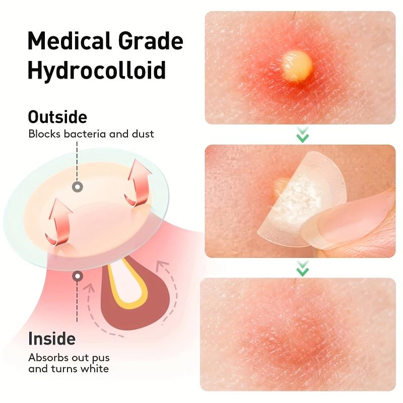 144 Pcs Hydrocolloid Acne Patches - Waterproof Pimple Patches