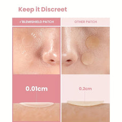 144 Pcs Hydrocolloid Acne Patches - Waterproof Pimple Patches