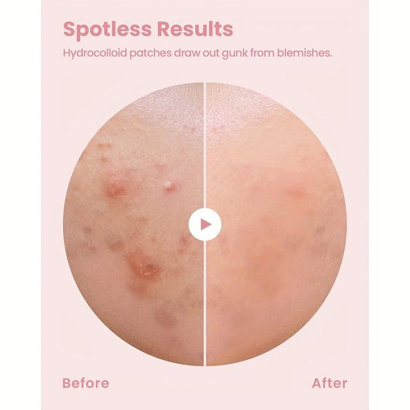 144 Pcs Hydrocolloid Acne Patches - Waterproof Pimple Patches