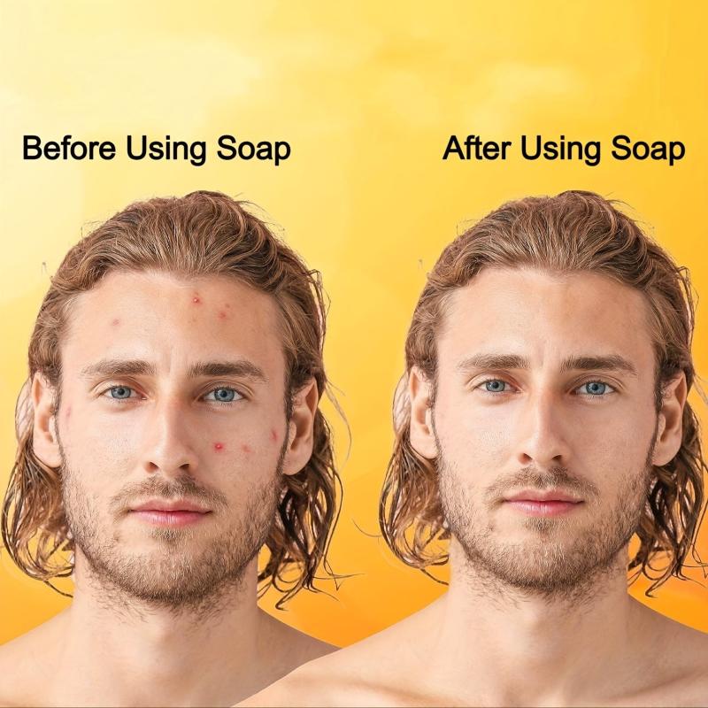 African Soap 2 X 65g Bars Raw Organic Soap Acne Dry Skin Rashes Scar Removal