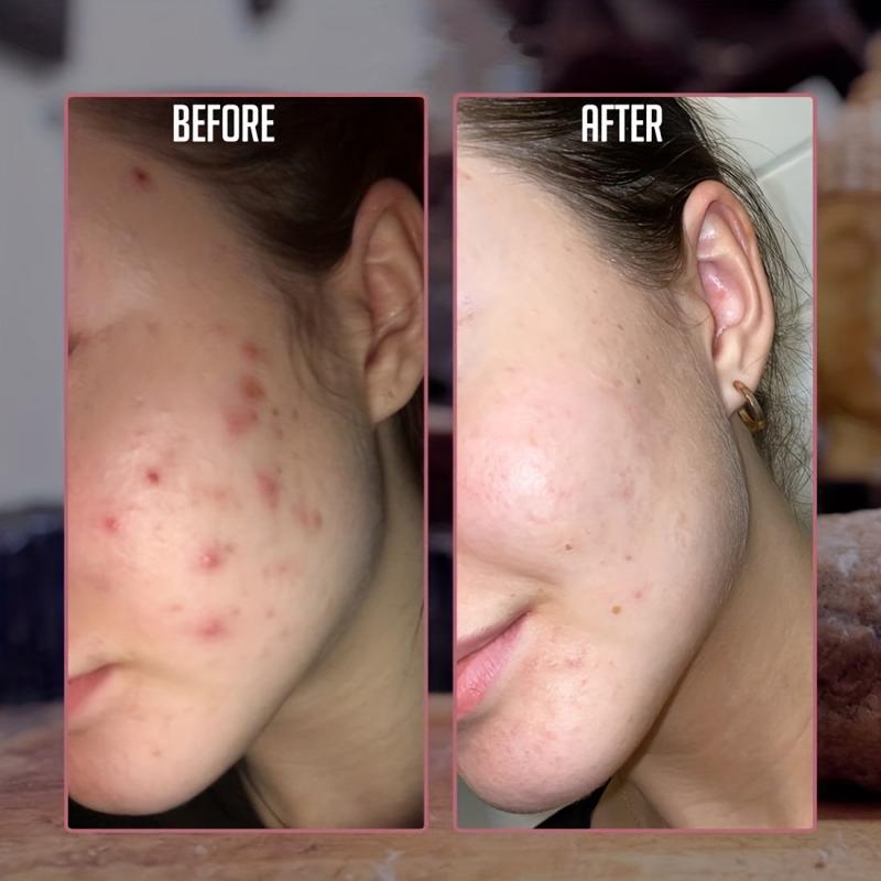 African Soap 2 X 65g Bars Raw Organic Soap Acne Dry Skin Rashes Scar Removal
