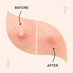 Acne Pimple Patch for Covering Zits and Blemishes - Vegan Friendly
