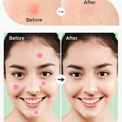 Pink Acne Pimple Patches Hydrocolloid Cover Blemish Spot Stickers 36pcs