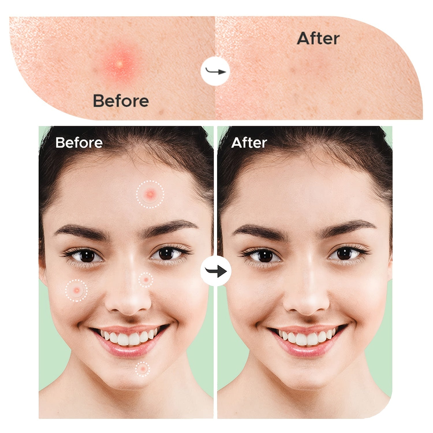 36 Ultra Thin Hydrogel Acne Patches 2 Sizes Waterproof Breathab
