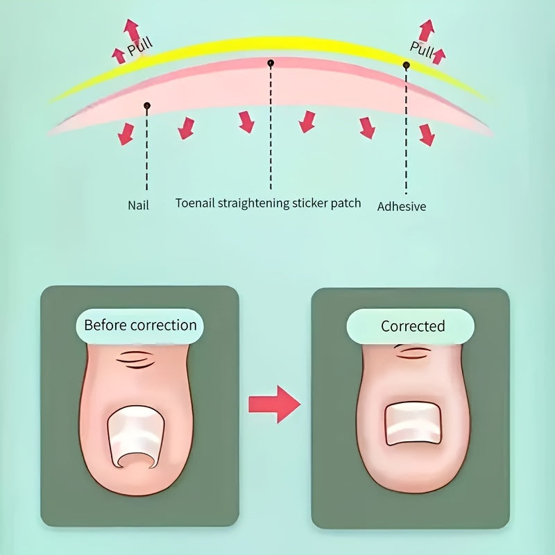 50pcs Ingrown Toenail Corrector Stickers Glue Solution For Toe Nails
