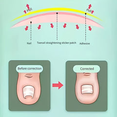 50pcs Ingrown Toenail Corrector Stickers Glue Solution For Toe Nails
