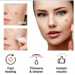Acne Pimple Patches Hydrocolloid Stars 36pcs